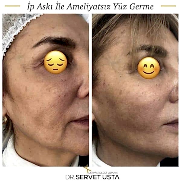 Ameliyatsız Estetik